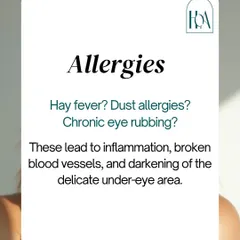 Do you suffer from allergies? Chronic eye rubbing from hay fever or dust allergies leads to inflammation, broken blood vessels, and a darkening of the delicate under-eye skin, contributing to the appearance of dark circles.
