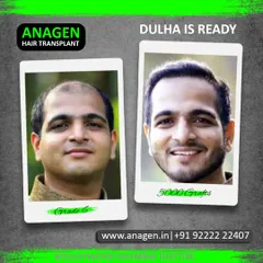 This transformation is why I do what I do. We took this patient from Grade 6 baldness to being "Dulha is Ready" with a 5000 graft procedure. Seeing this smile and renewed confidence is the ultimate reward.