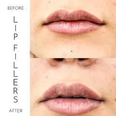 A clear example of how I approach lip fillers. The goal is always a natural enhancement, adding subtle volume and definition to create a balanced and hydrated look, not an overdone pout. This before-and-after shows a beautifully refreshed and defined lip shape.