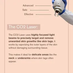 The CO2 Laser uses highly focused light beams to precisely target and remove unwanted skin growths like skin tags. It vaporizes the outer layers without damaging surrounding tissue, making it ideal for delicate areas.