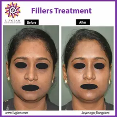 A clear demonstration of how dermal fillers can restore youthful contours. In this case, fillers were used to add volume to the cheeks and soften under-eye hollows, resulting in a lifted and less tired appearance.