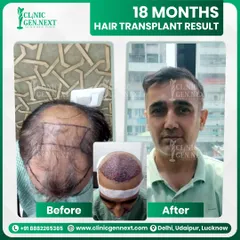 This is a fantastic transformation after 18 months using my Hybrid-DHI/FUE technique. We successfully covered a large area of baldness, achieving a dense, natural, and confident look for the patient.