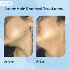This before-and-after showcases the effectiveness of our USFDA-approved laser for facial hair removal. The treatment is precise and safe for Indian skin, providing a long-term solution to unwanted hair without irritation.