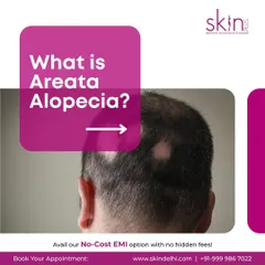 This image shows an example of Areata Alopecia, which is characterized by patchy hair loss. I provide targeted treatments to address this autoimmune condition and encourage hair regrowth in the affected areas.