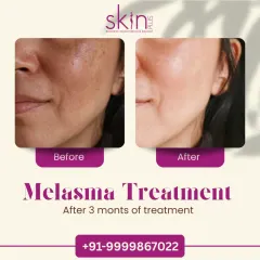 This before-and-after image displays the significant improvement in melasma after just three months of my customized treatment plan. It shows my capability in managing complex pigmentation issues and achieving a more even and radiant skin tone.