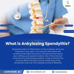 This graphic explains Ankylosing Spondylitis, a type of arthritis that affects the spine. Our physical therapy programs focus on improving flexibility and posture to manage symptoms and maintain mobility.