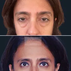 This patient was concerned about her under-eye bags, which gave her a perpetually tired look. The after photo shows the result of a blepharoplasty procedure, which has refreshed her entire appearance, making her look younger and brighter.
