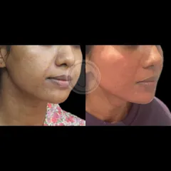 This before-and-after image highlights the improvement in the lower face and jawline definition. My goal with facial contouring is always to create natural-looking results that restore structure and youthfulness.