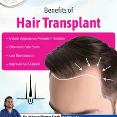A hair transplant offers several key benefits. It provides a permanent solution to hair loss, eliminates bald spots, is low maintenance once the hair grows in, and significantly improves self-esteem.