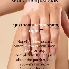 Vitiligo is more than just skin deep. It occurs when pigment-producing cells stop functioning. Understanding the science behind the patches is the first step in managing the condition.