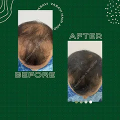 Here is another clear example of the results possible with GFC therapy. The 'after' photo shows improved scalp coverage and thicker hair, demonstrating a successful outcome for treating male pattern baldness.