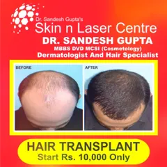 This is a clear example of how a successful FUE hair transplant can completely restore a natural-looking hairline and reverse advanced baldness. The results are permanent, giving you back not just your hair, but your confidence.