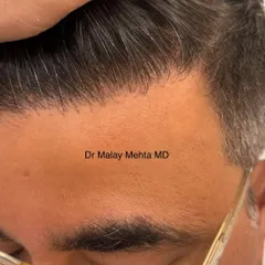 This close up highlights the soft transition from the forehead to the hair. There are no harsh lines or "pluggy" looking grafts. This micro and macro irregularity is the hallmark of a natural, artistic hair transplant.