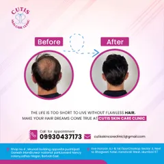 See the clear difference our hair restoration treatment makes. This before and after comparison shows a patient's journey from a thinning crown to a scalp with significantly improved hair coverage and thickness, making their hair dreams a reality.