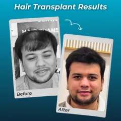 From significant thinning on top to a full head of hair, this transformation is a testament to what is possible with a well-planned hair transplant. The patient's satisfaction is evident.