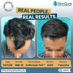 This 24-year-old patient presented with Norwood Grade III hair loss. We transplanted 2600 grafts, focusing on rebuilding a strong hairline and filling the thinning temples. The 7-month result shows significant growth and a much fuller look.