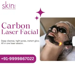 Here you can see the Carbon Laser Facial in action. I use a layer of liquid carbon paired with a precise laser to deeply exfoliate the skin, minimize pores, and reduce oiliness for an immediate, polished glow.