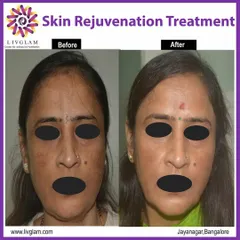 Our targeted skin rejuvenation treatment effectively addressed this client's significant pigmentation and uneven skin tone. The result is a brighter, more uniform complexion and visibly healthier skin.