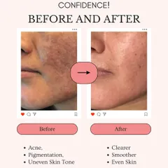 From acne, pigmentation, and uneven tone to clearer, smoother skin. This before and after is a testament to our customized treatment plans that deliver real, confidence-boosting results.
