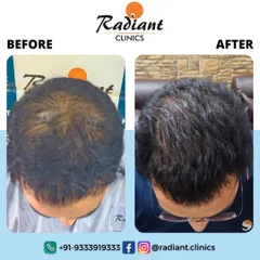 This is a clear before-and-after comparison for a patient who underwent PRP treatment. On the left, you can see the scalp is clearly visible through the thinning hair. The photo on the right shows the same patient after completing the treatment course, with significantly improved hair volume and scalp coverage.