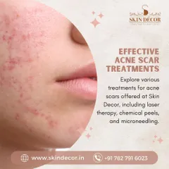 Don't let acne scars affect your confidence. I offer a range of effective treatments tailored to your specific needs, including advanced laser therapy, customized chemical peels, and precision microneedling to promote smoother, clearer skin. We can discuss which option is best for you during our consultation.