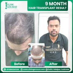 This patient achieved a full, natural-looking head of hair just 9 months after his procedure with me. We focused on restoring density to the crown and frontal area, giving him back his confidence.