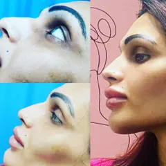 Non-surgical facial contouring allows for remarkable enhancements without any incisions. Here, I used dermal fillers to augment the lips, refine the nose bridge, and strengthen the chin and jawline. This kind of profile balancing creates harmony across all facial features.