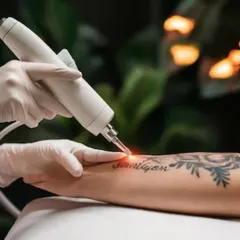 This is a close up of a laser tattoo removal session at my clinic. The advanced Q-switch laser precisely targets the ink particles under the skin, breaking them down safely over several sessions. This method allows for effective removal of unwanted tattoos with minimal risk of scarring.