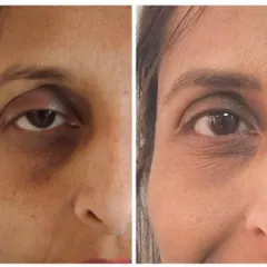 This before-and-after image showcases a subtle, natural-looking under-eye rejuvenation. Our goal is to enhance your appearance so that you look rested and confident, without anyone knowing you've had an injectable treatment.