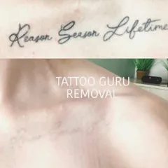 This client wanted to remove a quote from their collarbone. The after photo shows the skin almost completely clear, with only very faint traces of the old ink remaining.