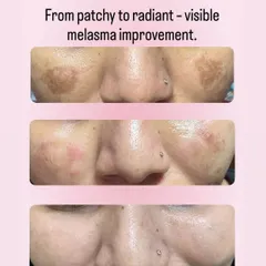 Melasma can be stubborn, but with the right approach, we see incredible improvements. This before-and-after shows a visible reduction in patchy pigmentation after a personalized treatment plan. Getting an even, radiant skin tone is absolutely possible.