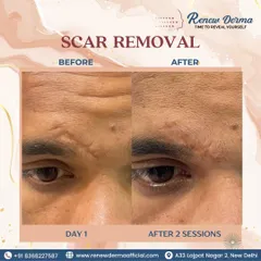 This client saw a noticeable improvement in his forehead scar after just two sessions. We create customized plans to effectively treat and reduce the visibility of old scars.