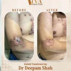 This was a challenging case of extensive and hard keloids on the chest and arm. I created a multi-step treatment plan using intralesional injections and fractional CO2 laser to break down the tough scar tissue. The 'after' photo shows a significant flattening and reduction, making the skin much smoother and more comfortable for the patient.
