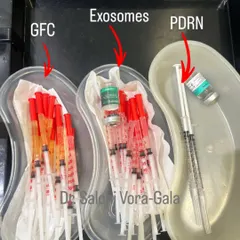 This is what science-backed hair restoration looks like. In my clinic, we use advanced regenerative treatments like GFC (Growth Factor Concentrate), Exosomes, and PDRN. These are not magic potions; they are powerful biological tools that signal your own body to heal, repair, and stimulate hair follicles at a cellular level.