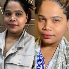 A clear example of the brightening results from my Korean Whitening Treatment. This before and after shot shows a significant reduction in dullness and a much more radiant and even skin tone.