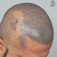 This patient came to us for a corrective hair transplant. We used 5500 grafts to recreate his hairline and re-densify the frontal part, mid-scalp, and crown.