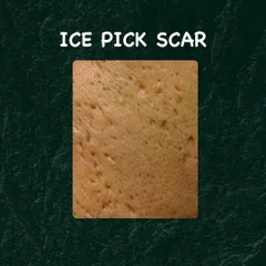 Ice pick scars are deep, narrow scars that can be challenging to treat. I use targeted methods like TCA CROSS peels to address this specific type of scarring.