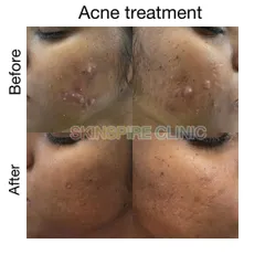 Another example of our customized acne treatment, showing a visible reduction in pustules and inflammation. We focus on a two-step process: first calming the skin, then treating the residual marks.