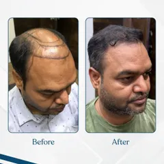 A receding hairline and thinning on the crown can be completely reversed. This before and after photo shows a significant increase in density and a natural-looking result after a successful hair restoration procedure at our clinic.