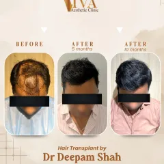 See the journey, not just the result. This collage shows the progress from the day of the procedure to early growth at 5 months, and the final dense, natural look at 10 months. Good things take time, and I am with you at every step.