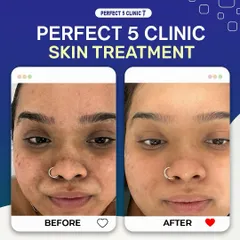This before and after photo highlights the effectiveness of our skin treatments on acne and pigmentation. The result is a clearer, more even-toned complexion and a visible reduction in blemishes.