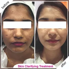 Our skin clarifying treatment effectively reduced pigmentation and improved this client's overall skin texture, leaving her with a healthy, radiant glow.