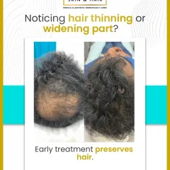 This before-and-after result for hair thinning demonstrates the effectiveness of a multi-pronged treatment plan. Early intervention is key to preserving hair and achieving visible density improvement.