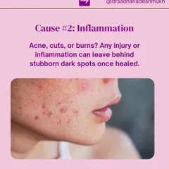 Any form of skin inflammation, whether from acne, cuts, or burns, can leave behind stubborn dark spots after the initial injury has healed. This is known as post-inflammatory hyperpigmentation (PIH).