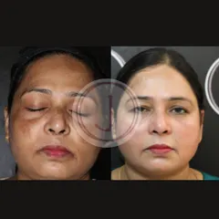 A clear before-and-after of a patient treated for hyperpigmentation. We used a series of depigmenting peels without any harsh steroids to safely lift away dark spots and reveal healthier skin.