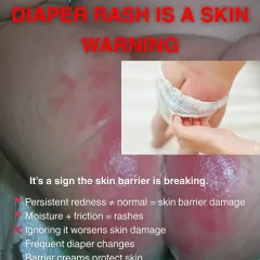 Diaper rash is more than just redness; it is a warning sign that your baby's skin barrier is breaking down. I help parents understand how to protect this delicate area and treat rashes effectively to prevent further damage.