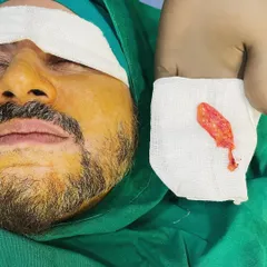 This image shows the size of the buccal fat pad relative to the patient's face. The removal is done through a small incision inside the mouth, so there are no visible external scars.