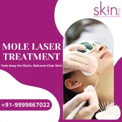 An image promoting my mole laser treatment, promising to fade away marks and welcome clear skin through a safe and effective procedure.