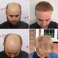 This four-panel image documents one of our most comprehensive transformations, taking a patient from advanced Grade 7 baldness to a full head of hair. This case shows that even with extensive hair loss, remarkable results are achievable.