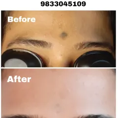 Another successful forehead tattoo removal. Notice the protective goggles worn in the 'before' shot, which are standard for any work near the eyes.
